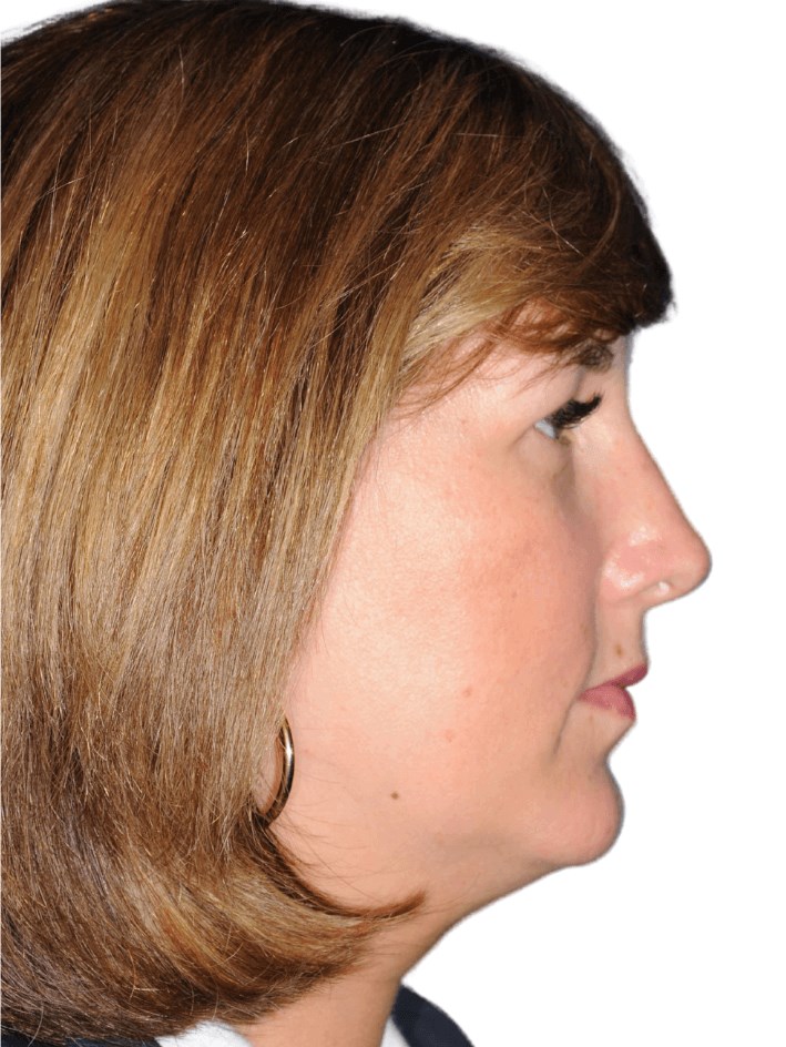 After Image