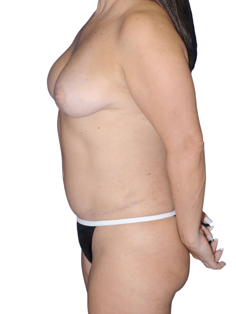 Side View - Full Body After Side View - Full Body After