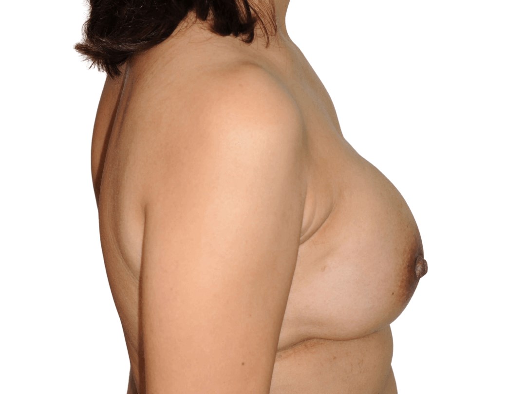 Side View After Side View After