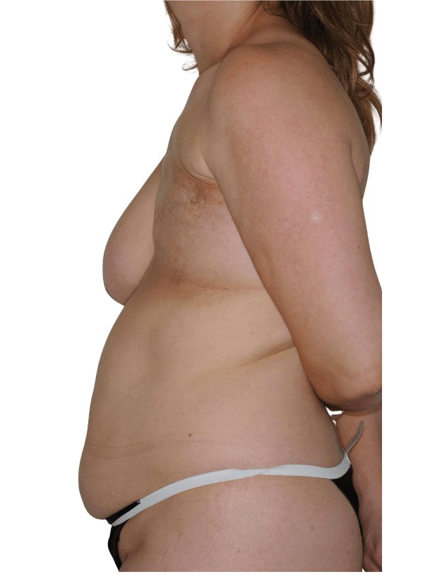 Side View Before Side View Before