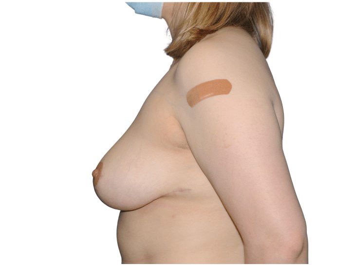 Side View After Side View After