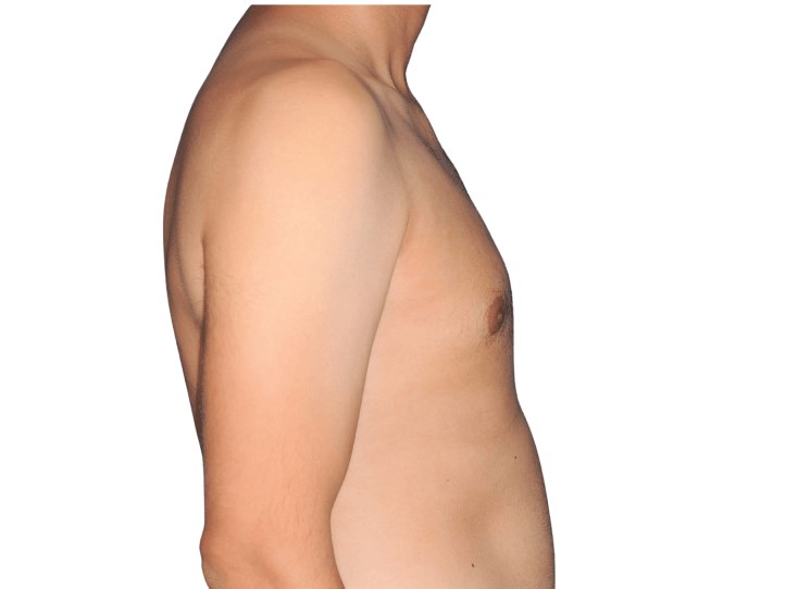 Lateral right view After Lateral right view After