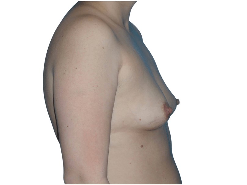 Side View Before Side View Before