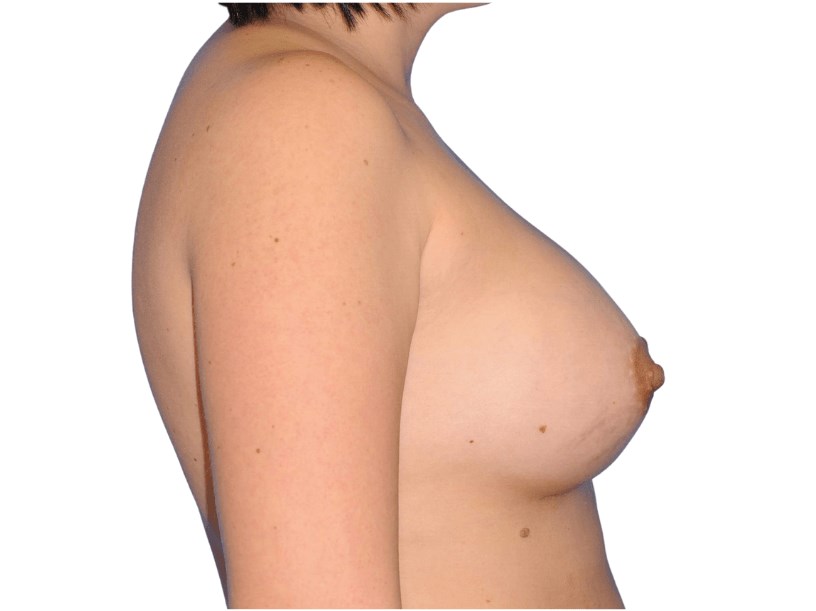 Side View After Side View After