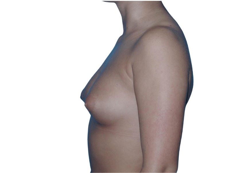 Side Views Before Side Views Before