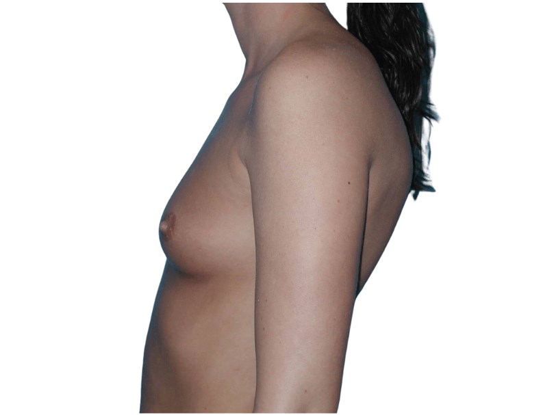 Side View Before Side View Before