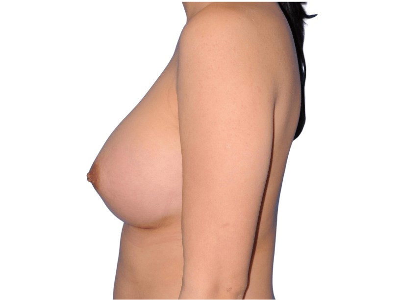 Side View Left After Side View Left After