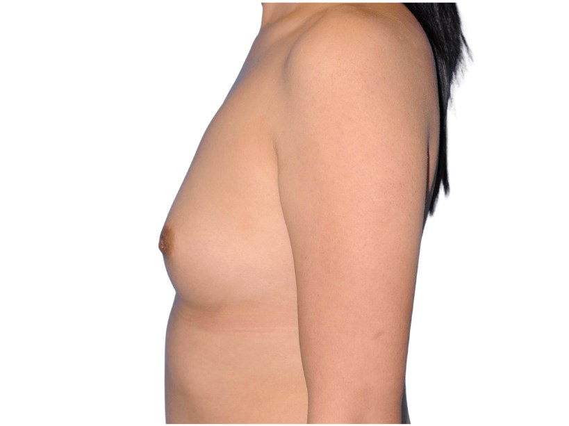 Side View Left Before Side View Left Before