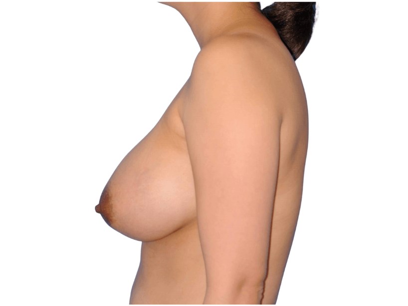 Side View After Side View After