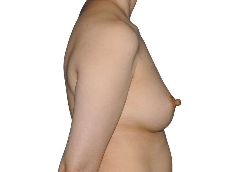 side view Before side view Before