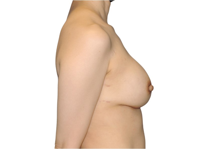 side view After side view After