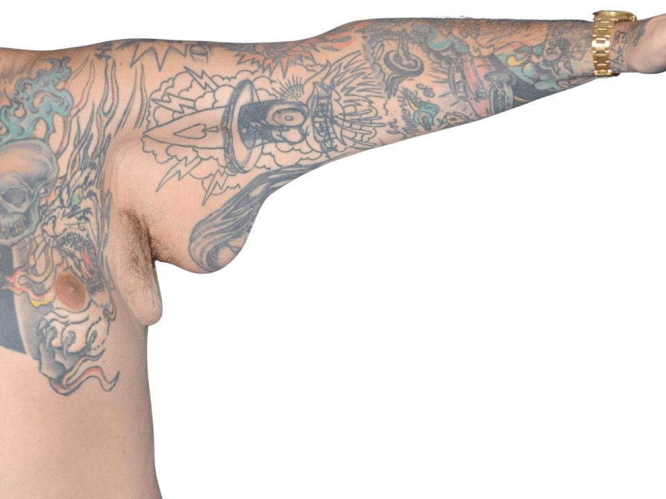 Left Arm Before Left Arm Before