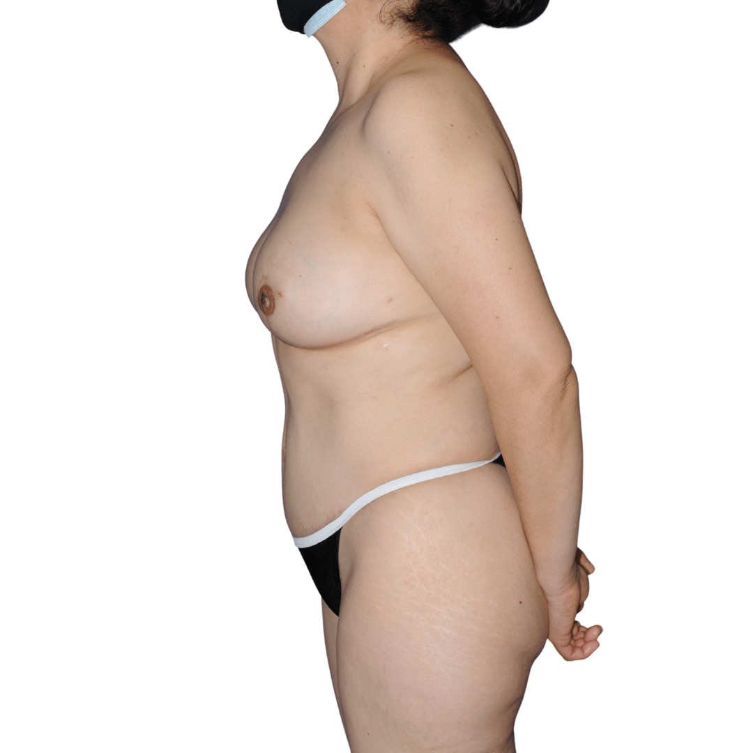 Lateral Left View After