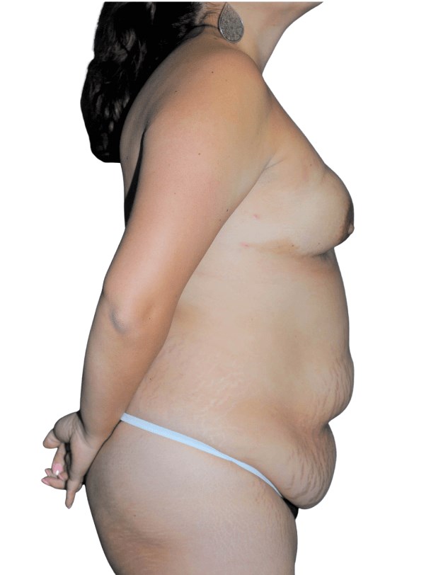 Lateral left view Before