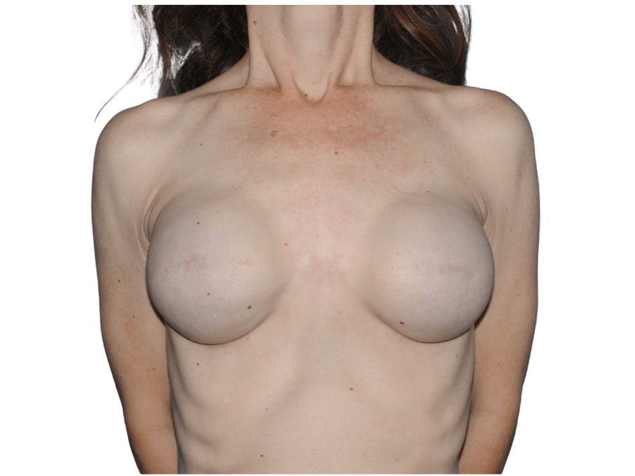 3D Aerola/Nipple Tattoo Before