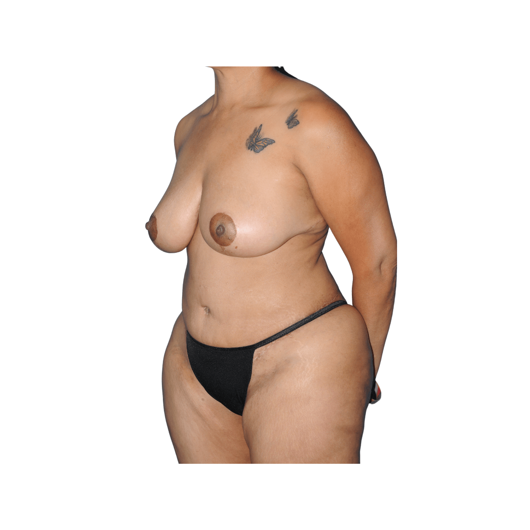 Prior to liposuction After