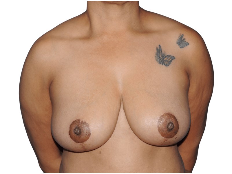 Breast Reduction/Lift After