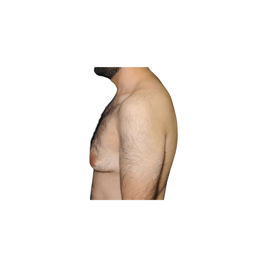 Lateral left view Before