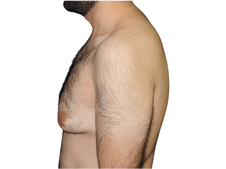 Lateral left view Before