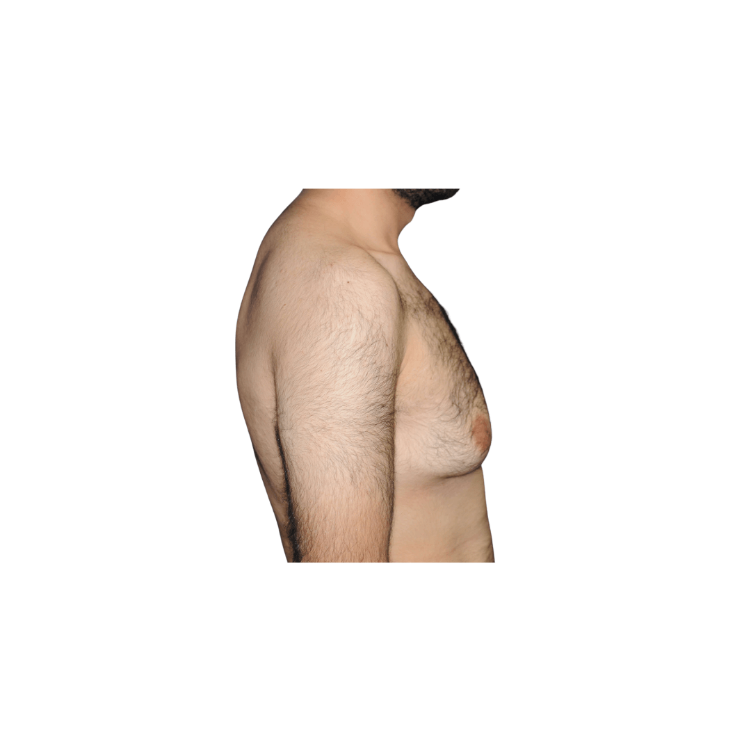 Lateral right view Before