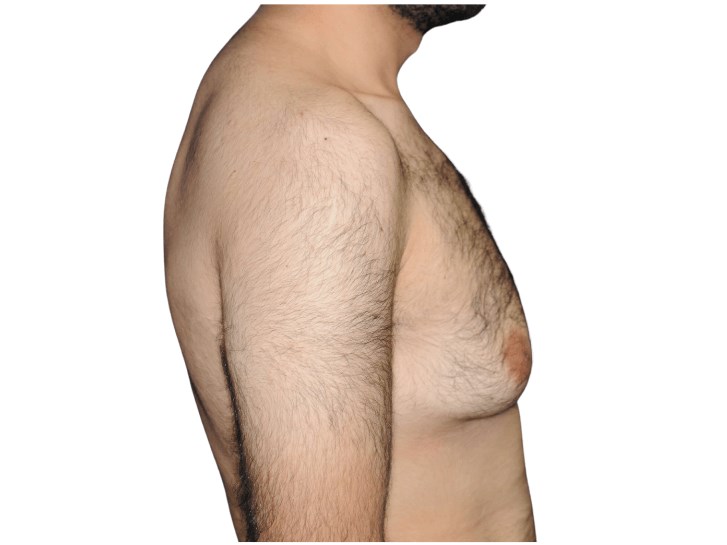 Lateral right view Before