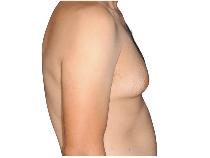 Lateral right view Before