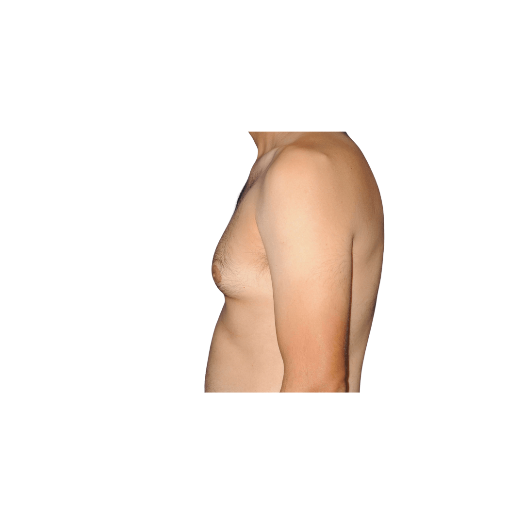 Lateral left view Before