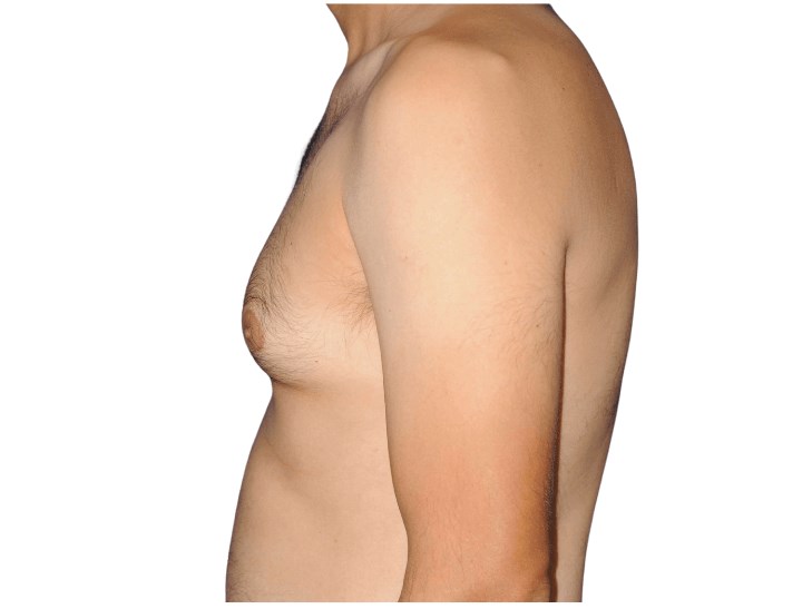 Lateral left view Before