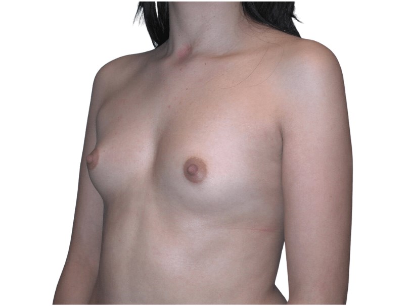 3/4 View Left Before