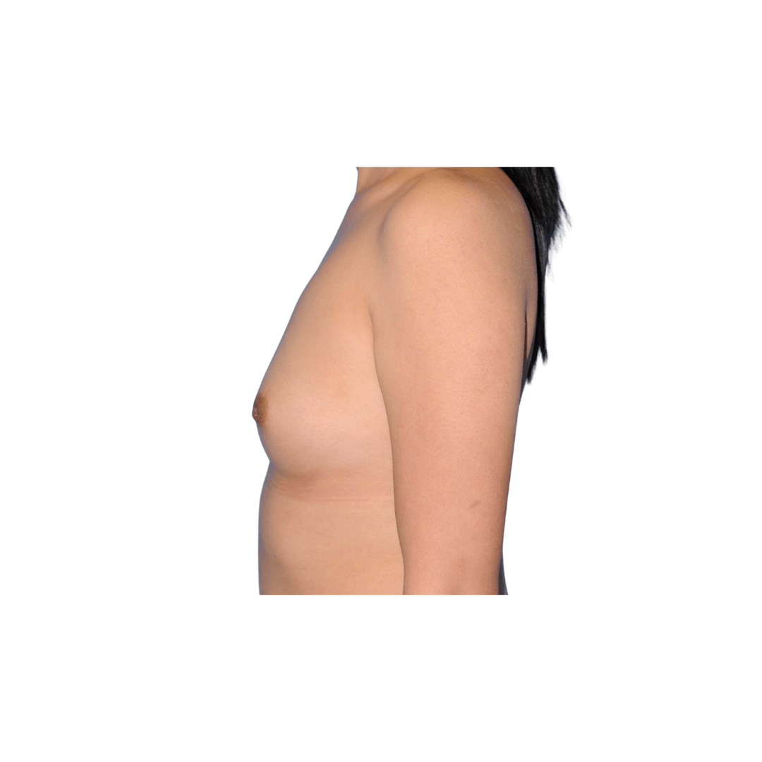 Side View Left Before